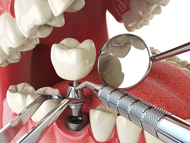 Best Urgent Care for Lost Fillings or Crowns in Manassas Park, VA